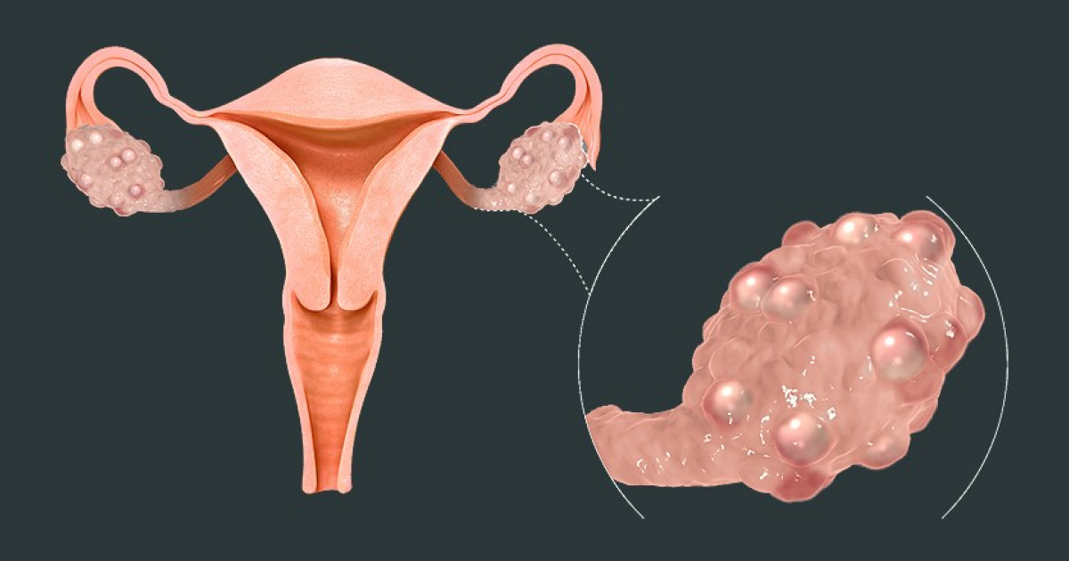 Влияние кетогенной диеты на уровень свободного тестостерона у женщин с синдромом поликистозных яичников