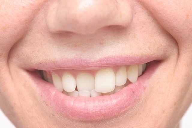 1713690571 266 Зубы в оковах Ортодонт рассказала зачем исправлять прикус у детей