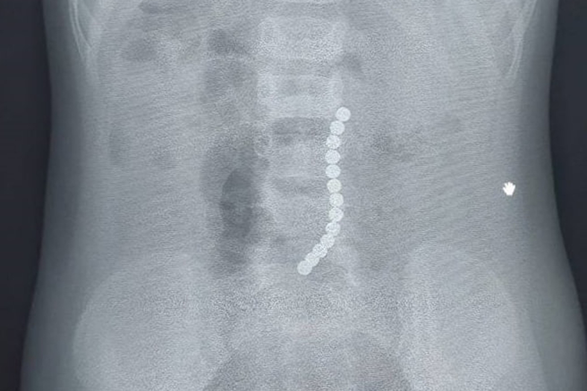 Двухлетняя девочка проглотила чертову дюжину магнитов